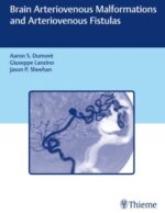 brain arteriovenous malformations and arteriovenous fistulas