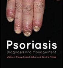Psoriasis: Diagnosis and Management 1st Edition