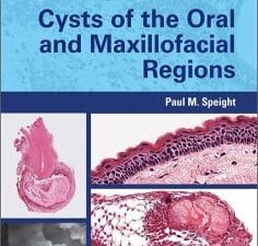 Shear’s Cysts of the Oral and Maxillofacial Regions 5th Edition