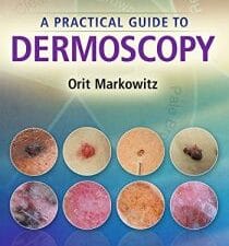 A Practical Guide to Dermoscopy