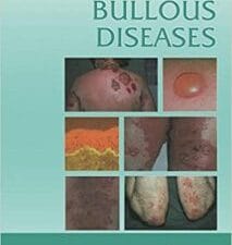 Atlas of Bullous Diseases
