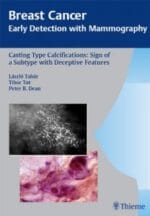 casting type calcifications: sign of a subtype with deceptive features