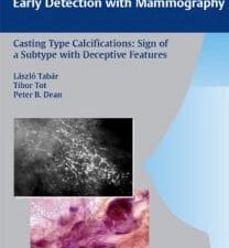 casting type calcifications: sign of a subtype with deceptive features