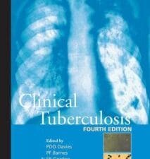 clinical tuberculosis