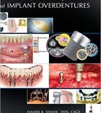clinical and laboratory manual of implant overdentures