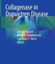 collagenase in dupuytren disease
