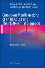 cutaneous manifestations of child abuse and their differential diagnosis: blunt force trauma