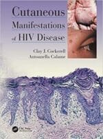 cutaneous manifestations of hiv disease 1st edition