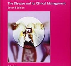 Dental Caries: The Disease and Its Clinical Management 2nd Edition
