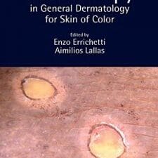 Dermoscopy in General Dermatology for Skin of Color