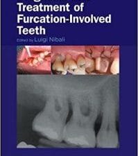 Diagnosis and Treatment of Furcation-Involved Teeth