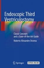 endoscopic third ventriculostomy: classic concepts and a state of the art guide