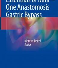 essentials of mini ‒ one anastomosis gastric bypass