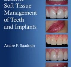 Esthetic Soft Tissue Management of Teeth and Implants