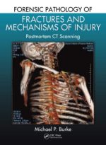 forensic pathology of fractures and mechanisms of injury: postmortem ct scanning