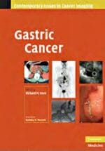 gastric cancer