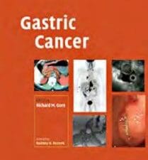 gastric cancer