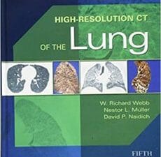 high resolution ct of the lung