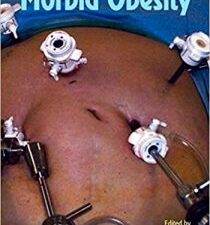 management of morbid obesity 1st edition