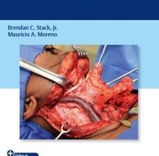 neck dissection