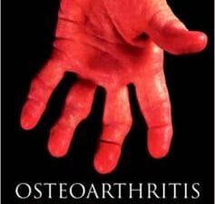 osteoarthritis