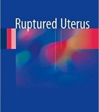 ruptured uterus