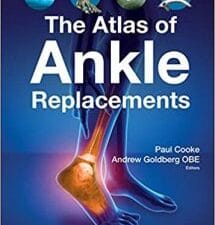 the atlas of ankle replacements