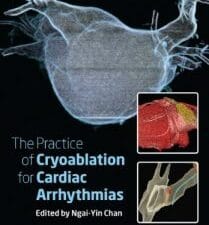 The Practice of Catheter Cryoablation for Cardiac Arrhythmias