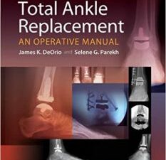 total ankle replacement: an operative manual first edition
