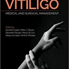 Vitiligo: Medical and Surgical Managmement