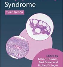 polycystic ovary syndrome 3rd edition