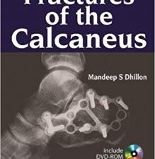 fractures of the calcaneus 1st edition