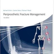 periprosthetic fracture management 1st edition