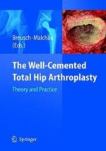 the well cemented total hip arthroplasty: theory and practice