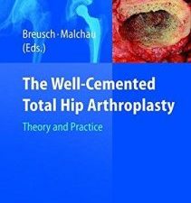 the well cemented total hip arthroplasty: theory and practice