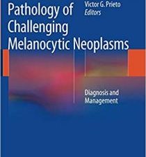 pathology of challenging melanocytic neoplasms: diagnosis and management