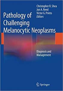 pathology of challenging melanocytic neoplasms: diagnosis and management