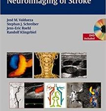 neurosonology and neuroimaging of stroke har/dvd edition
