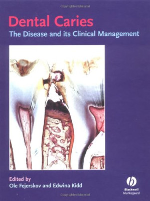dental caries: the disease and its clinical management