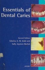 essentials of dental caries: the disease and its management