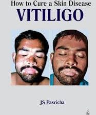 how to cure a skin disease: vitiligo 1st edition