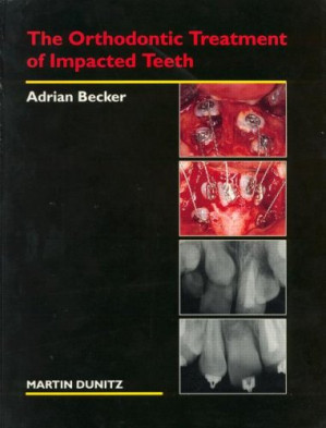 impacted teeth