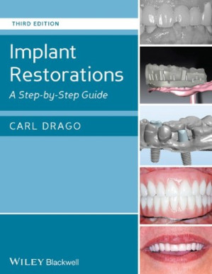 implant restorations: a step by step guide (3rd edition – 2014)