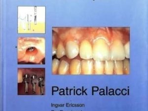 optimal implant positioning and soft tissue management for the branemark system