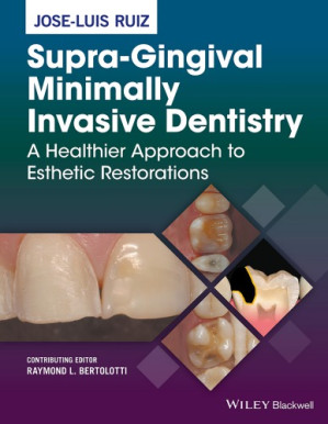 supra gingival minimally invasive dentistry: a healthier approach to esthetic restorations