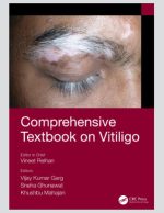 vitiligo