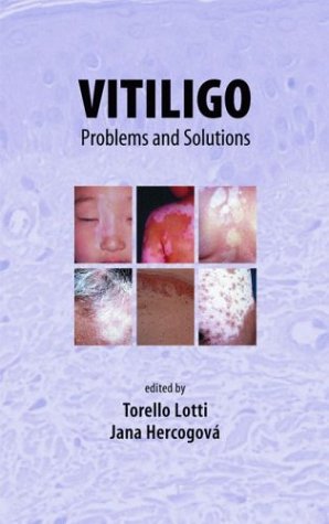 vitiligo: problems and solutions