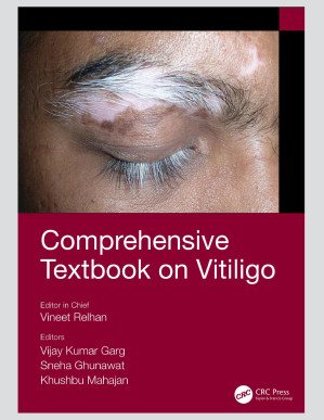 vitiligo