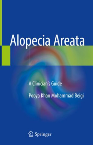 alopecia areata