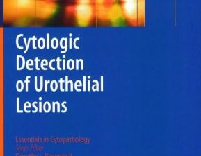 cytologic detection of urothelial lesions